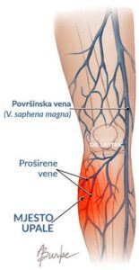 upala vene Thrombophlebitis