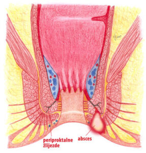 analni absces