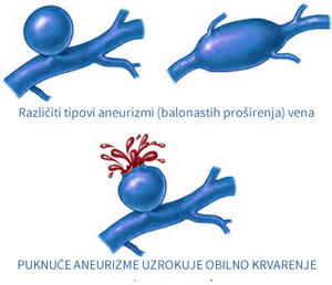 Krvarenje iz proširene vene aneurizma