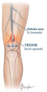 Duboka venska tromboza (Phlebothrombosis) dvt