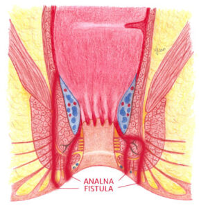 analna fistula