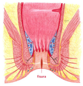 analna fisura