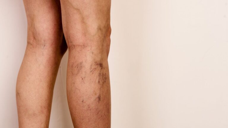 flebologija proširene vene